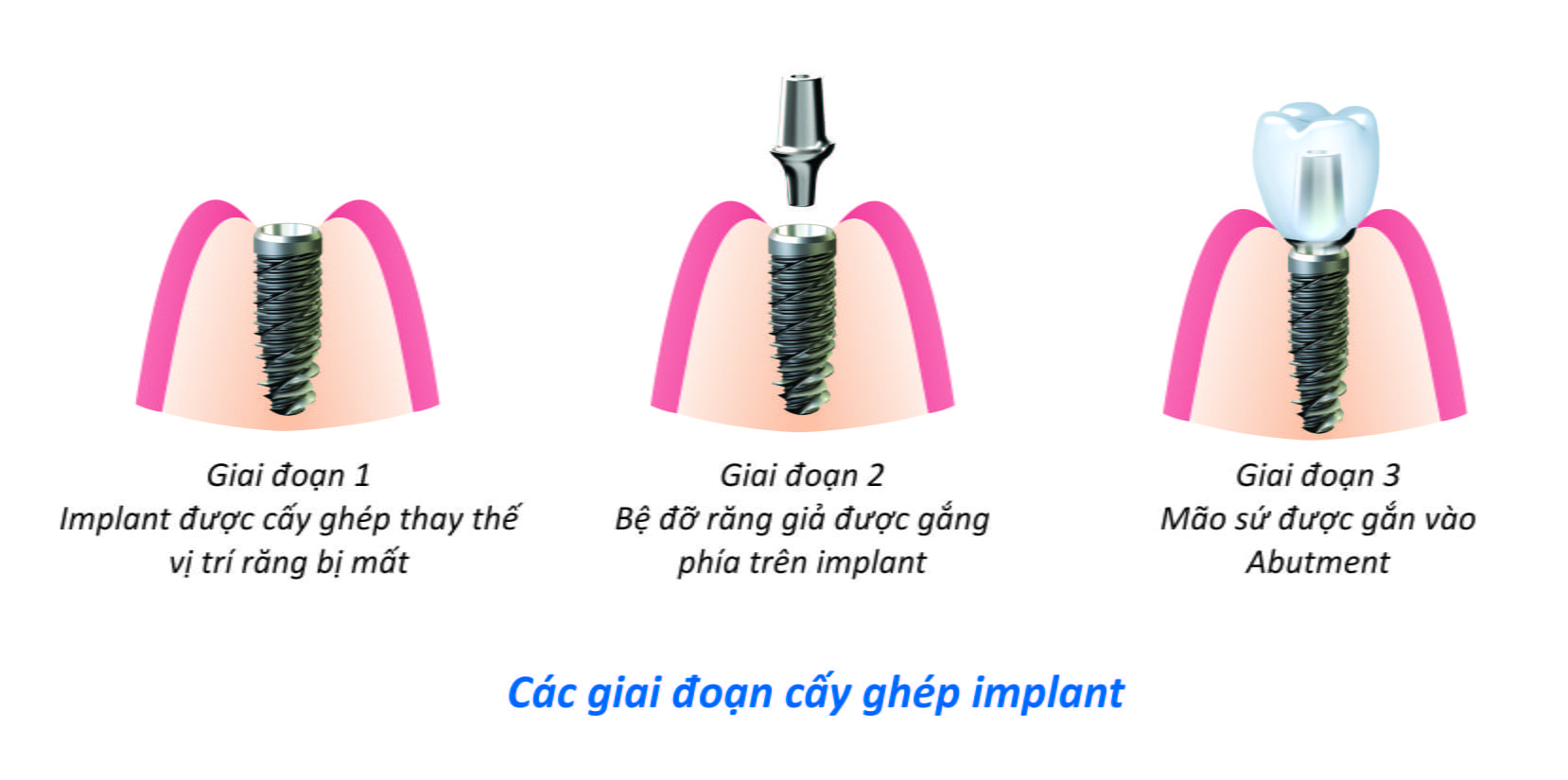 Cay ghep implant trong truong hop nao